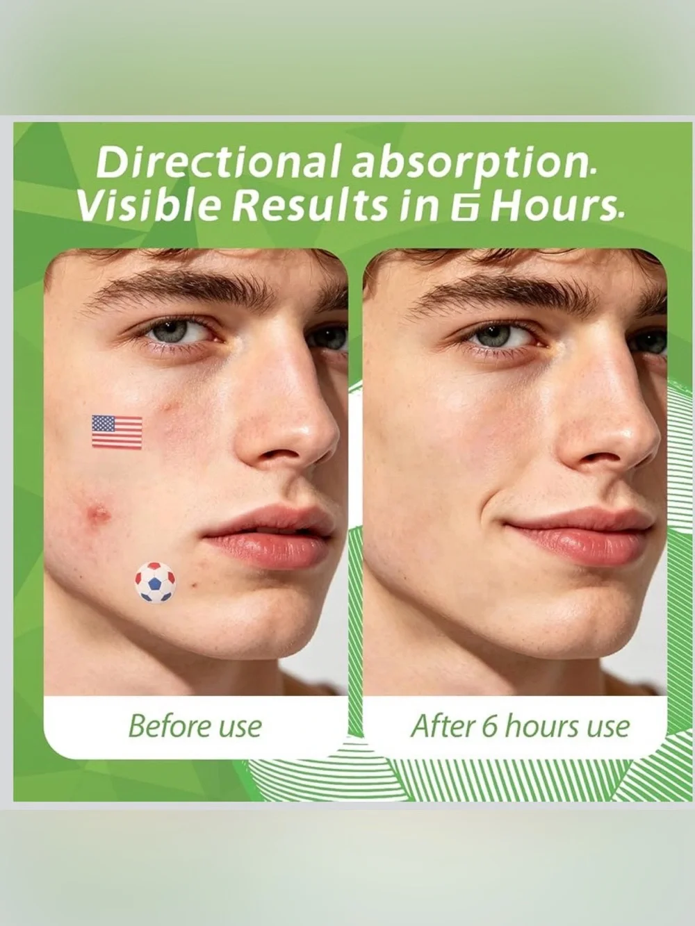 Anchiray hydrocolloid pimple